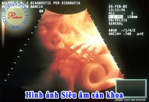 hình ảnh siêu âm sản khoa